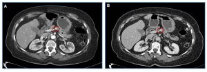 Figura 3. Insulinoma (TNE G1). TC con contraste intravenoso en fases arterial (A) y venosa (B). Lesión sólida (círculo) de pequeño tamaño, redondeada y de contornos bien definidos, en cuerpo de páncreas (*), hiperdensa respecto al parénquima pancreático en ambas fases, en relación con insulinoma. Imagen típica del insulinoma -> lesión de pequeño tamaño (