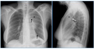 Figura 18. Tumor carcinoide típico. Radiografía de tórax postero-anterior (PA) y lateral. En proyección PA se identifica un aumento difuso de densidad (*) en campos pulmonares superior y medio izquierdo, con elevación del hilio y del hemidiafragma izquierdos (flechas negras), y en proyección lateral, vemos un aumento de densidad (*) en la región retroesternal, delimitado por un borde inferior muy bien definido (flecha blanca). Hallazgo típico de una atelectasia del LSI.