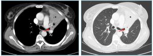 Figura 19. Tumor carcinoide típico. Paciente de la radiografía de la Figura 18. TC Torácico con contraste IV, ventanas de mediastino (A) y de parénquima (B). Se observa una lesión nodular, levemente hiperdensa, completamente intraluminal a nivel del bronquio del lóbulo superior izquierdo (flecha), que ocluye completamente su luz, condicionando una atelectasia lobar completa (*).