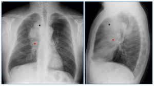 Figura 22. Carcinoma microcítico. Radiografía de tórax PA y lateral. Masa en hilio pulmonar derecho (*) y en región paratraqueal de mediastino superior (*), sugestivo de neoplasia pulmonar. Se realizó TC torácico, que se muestra en la siguiente figura.