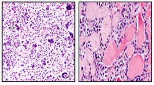 Figura 1. Citología. Los CMT está formado por células plasmocitoides, fusiformes u ovoides. Las flechas indican el depósito de amiloide.