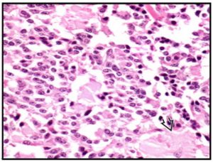 Figura 3. Carcinoma medular de tiroides. La flecha indica el depósito de amiloide.