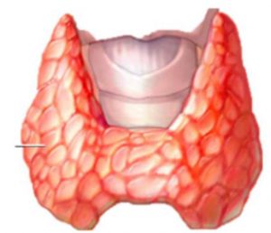 Figura 1. Esquema-dibujo del carcinoma medular de tiroides.