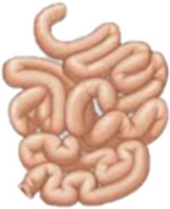 Figura 2. Esquema-dibujo de tumor neuroendocrino en intestino delgado.