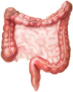 Figura 4. Esquema-dibujo de tumor neuroendocrino en colon-recto.