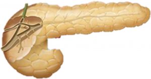 Figura 5. Esquema-dibujo de tumor neuroendocrino pancreático.