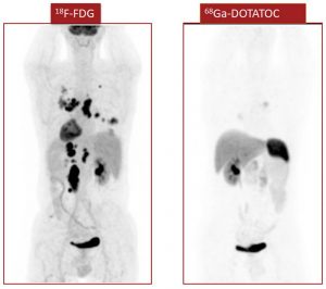 Figura 4. Paciente de 48 años con feocromocitoma metastásico. SDHB negativo en tejido. Se debe descartar la presencia de mutación en SDH, ya que la probabilidad es alta, por la mayor captación de FDG que ASS. Lo que indica mayor agresividad de la enfermedad en este paciente.