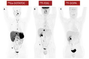 Figura 5. Imagen típica del fenotípica de un paciente con la mutación SDHB con paraganglioma retroperitoneal y metástasis óseas y ganglionares. Alta captación de 68Ga-DOTA-ASS, baja de 18F-FDG y nula de 18F-FDOPA.