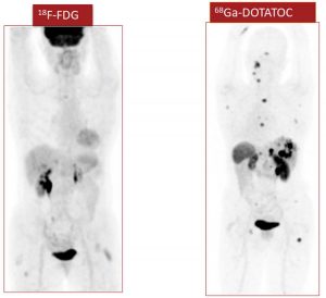 Figura 6. Paciente de 59 años con HNPGL metastásico; el 68Ga-DOTA-ASS, detecta más lesiones que la de 18F-FDG.
