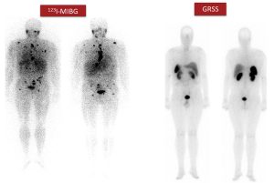 Figura 9. Selección de pacientes para terapia con radionúclidos. Como la gammagrafía con 123I-MIBG es positiva y la GRSS es negativa, este paciente es candidato a tratamiento con 131I-MIBG.