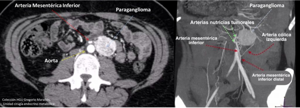Figura 1. Estudio de tomografía computarizada (TC) en fase arterial para planificación quirúrgica en un paraganglioma paraaórtico.